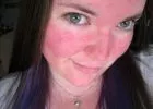 Létezik tartós megoldás is a rosacea-ra