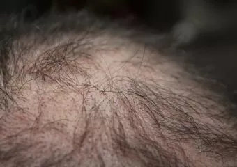 Autoimmun betegséget jelezhet, ha foltokban hullik a hajunk