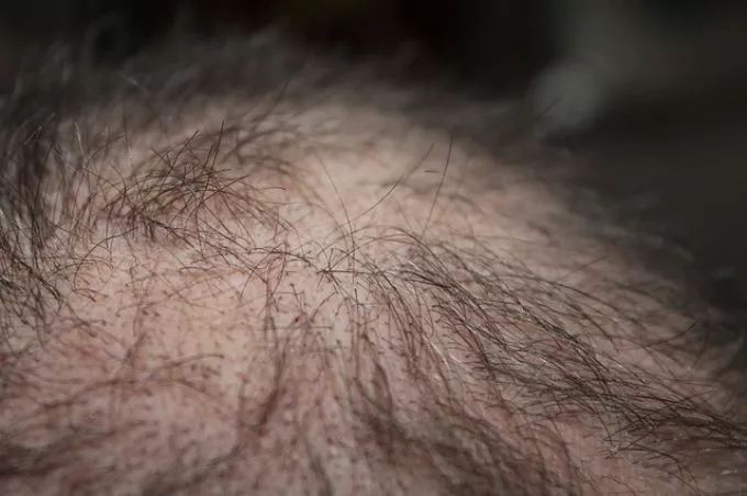 Autoimmun betegséget jelezhet, ha foltokban hullik a hajunk