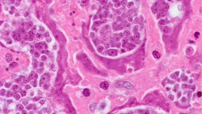 Először azonosítottak parazita daganatos sejtjei által okozott rákos megbetegedést embernél