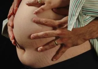 Mit tehetünk a terhességi csík ellen? 