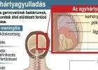 Az agyhártyagyulladás tünetei: ha ezt látod, azonnal vidd kórházba a gyereket!