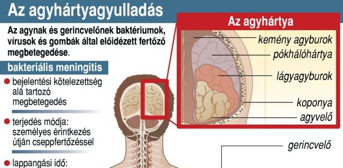 Az agyhártyagyulladás tünetei: ha ezt látod, azonnal vidd kórházba a gyereket! Az agyhártyagyulladás tünetei: ha ezt látod, azonnal vidd kórházba a gyereket!