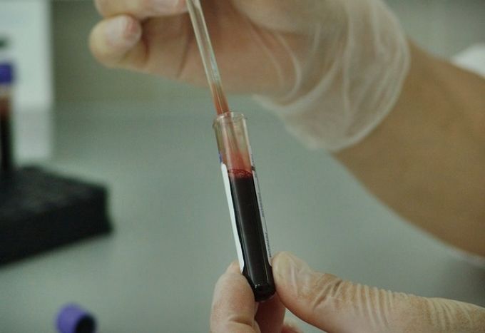 Egy olcsó vérvizsgálattal felderíthetők a rejtett szívbetegségek Egy olcsó vérvizsgálattal felderíthetők a rejtett szívbetegségek
