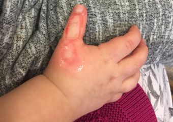 Csúnyán megégett a pici keze a porszívó miatt - anyukája hívja fel a figyelmet a veszélyre