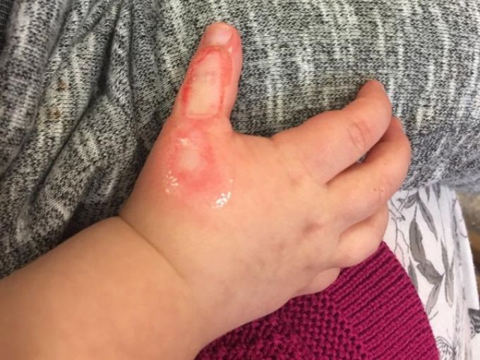Csúnyán megégett a pici keze a porszívó miatt - anyukája hívja fel a figyelmet a veszélyre