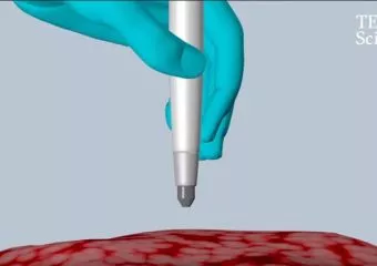Tíz másodperc alatt mutatja ki a rákos szövetet egy új "toll"