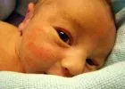 Újszülött- és csecsemőkori bőrelváltozások