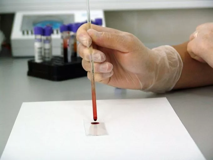 Új felfedezés: vérvizsgálat, mely kimutatja a rákot