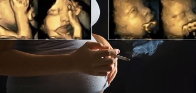 Beszédes ultrahang képek: szó szerint szenved a magzat, ha rágyújt az anya Beszédes ultrahang képek: szó szerint szenved a magzat, ha rágyújt az anya