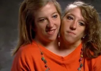 Közös testben is különálló egyéniségek: így él Abigail és Brittany, az amerikai sziámi ikerpár