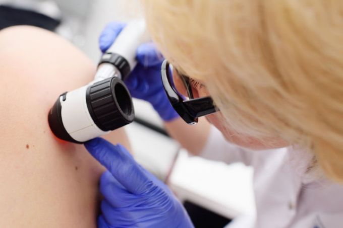 10 dolog, amit mindenkinek tudnia kell a melanomáról 10 dolog, amit mindenkinek tudnia kell a melanomáról