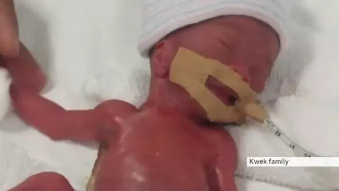 Így néz ki most a világ legkisebb babája, aki egy év után hagyhatta el a kórházat