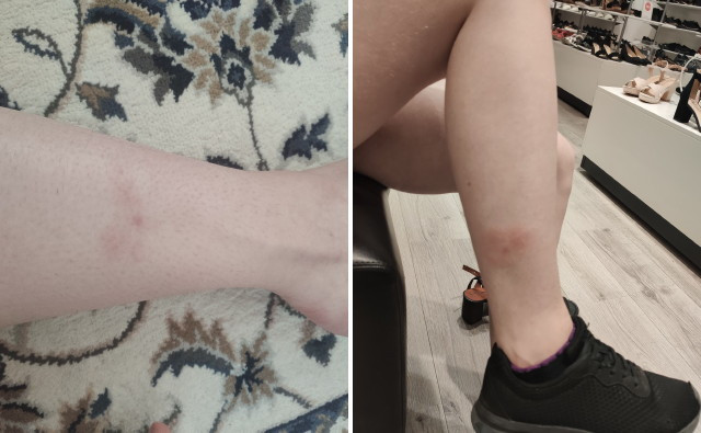 Lyme-kór jele: kullancscsípés okozta bőrpír